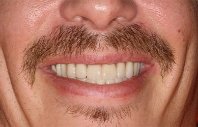 Smile gallary image - After